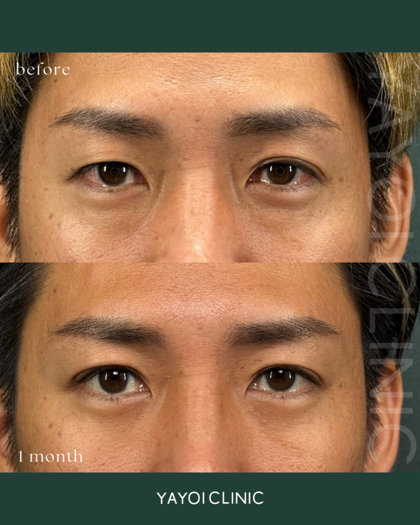 美容外科 目の下のクマたるみ取り(結膜脱脂術)＋二重埋没 自然癒着法(片目)