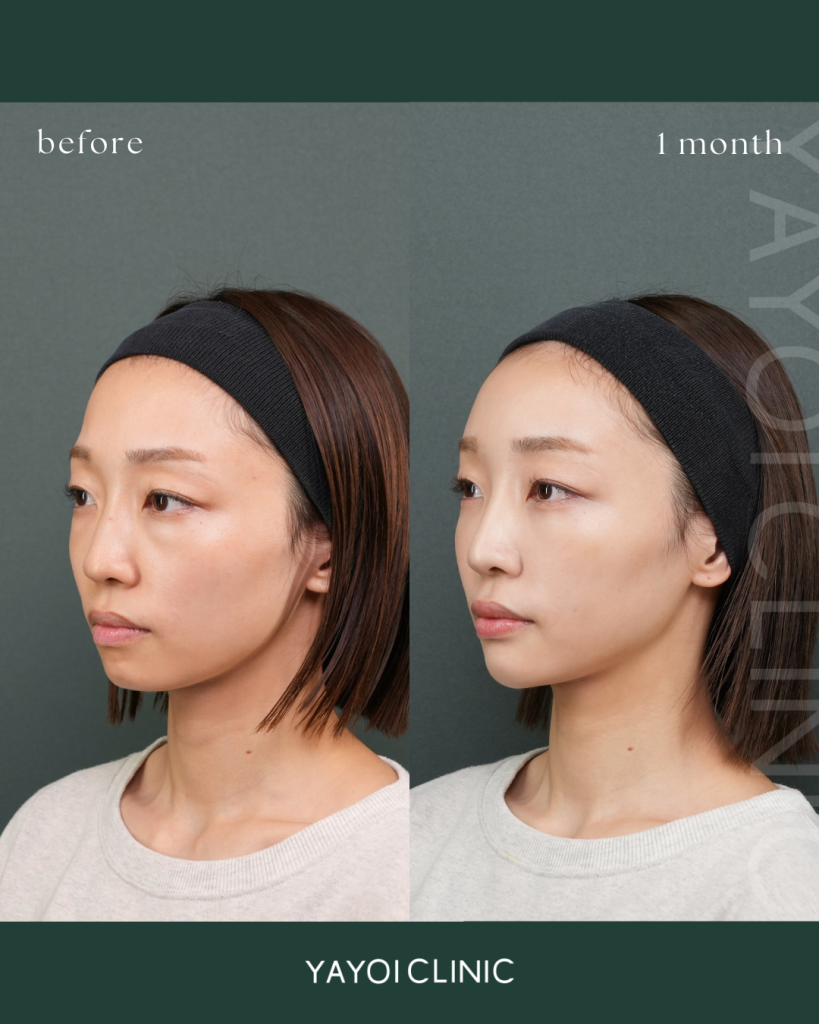 目の下のクマたるみ取り(結末脱脂術)＋脂肪注入(目の下・ゴルゴ・額・こめかみ・頬コケ) ＋ヒアルロン酸(鼻・唇・顎)＋顎ボトックス