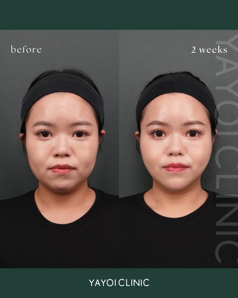 脂肪吸引×糸リフト×ヒアルロン酸(顎)×ボトックス(顎・エラ・耳下腺)