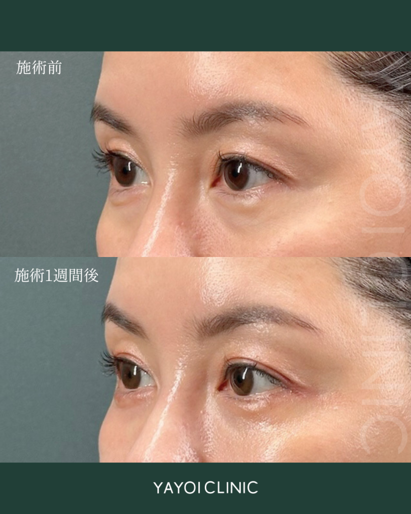 ベビーコラーゲン