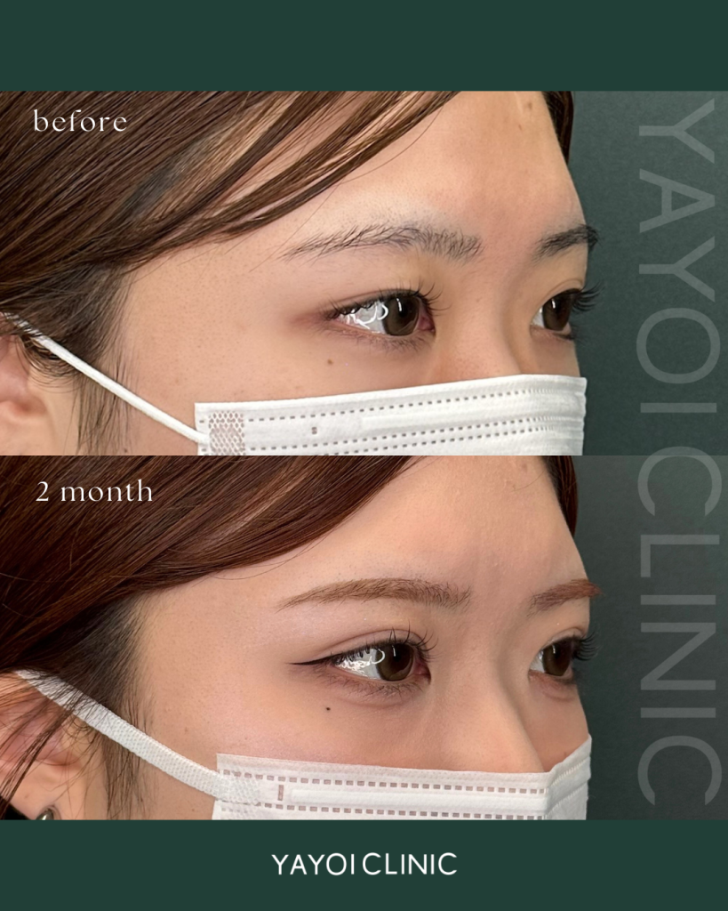 美容外科 二重埋没(4点留め)