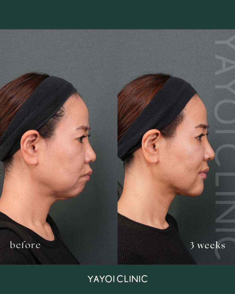 脂肪吸引×糸リフト×ヒアルロン酸(顎)×ボトックス(顎・エラ・耳下腺)