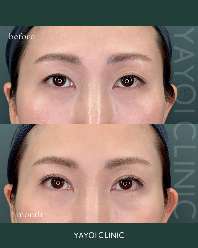 二重埋没(4点留め)