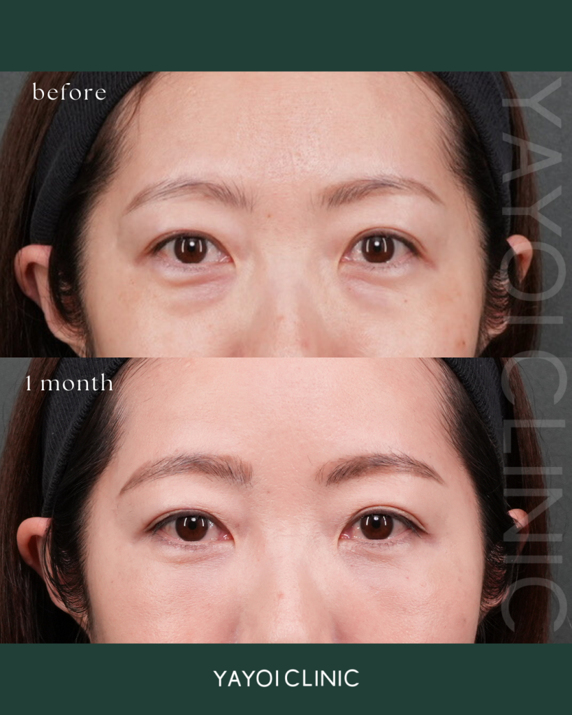 目の下のクマたるみ取り(結末脱脂術)＋脂肪注入(目の下・ゴルゴ)