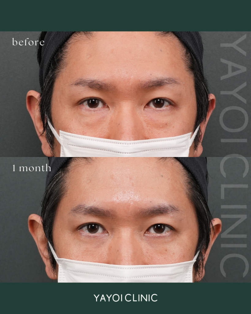 美容外科 目の下のクマたるみ取り(脱脂)