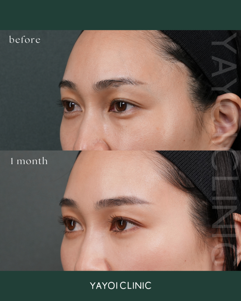 美容外科 目の下のたるみ・クマ 裏ハムラ法