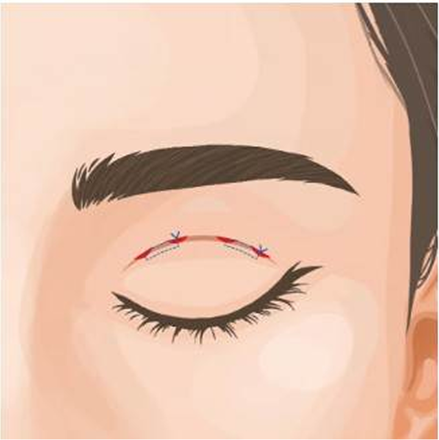 二重埋没法を広島で！メリットやデメリット、施術の流れなど解説