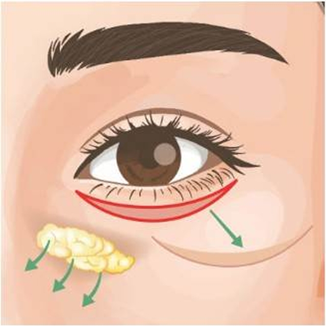 クマ取りを広島で！おすすめ施術やクリニック選びのポイントも解説