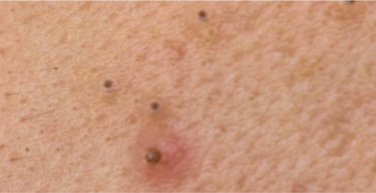 広島でニキビを本気で治したい方へ|美容皮膚科の種類別アプローチと施術の流れ