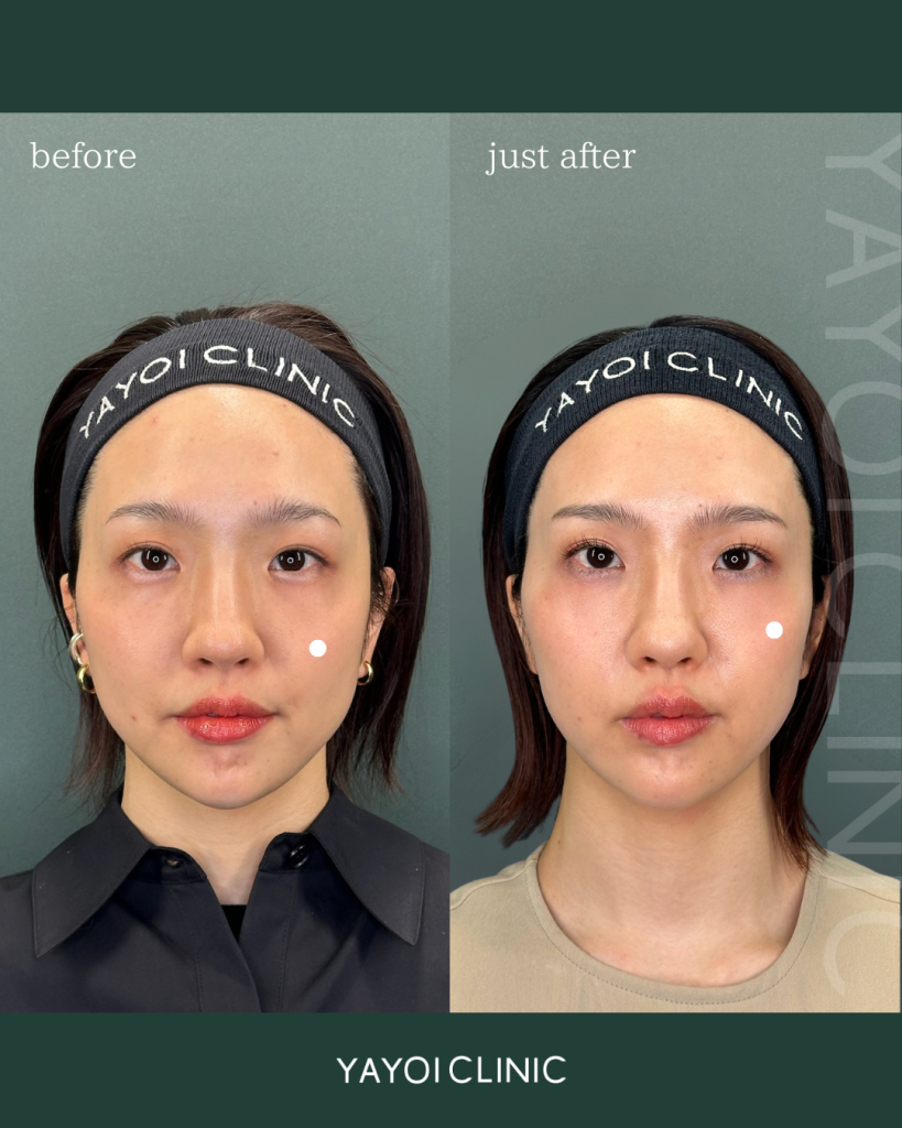 ショッピングリフト×糸リフト×サーマジェン