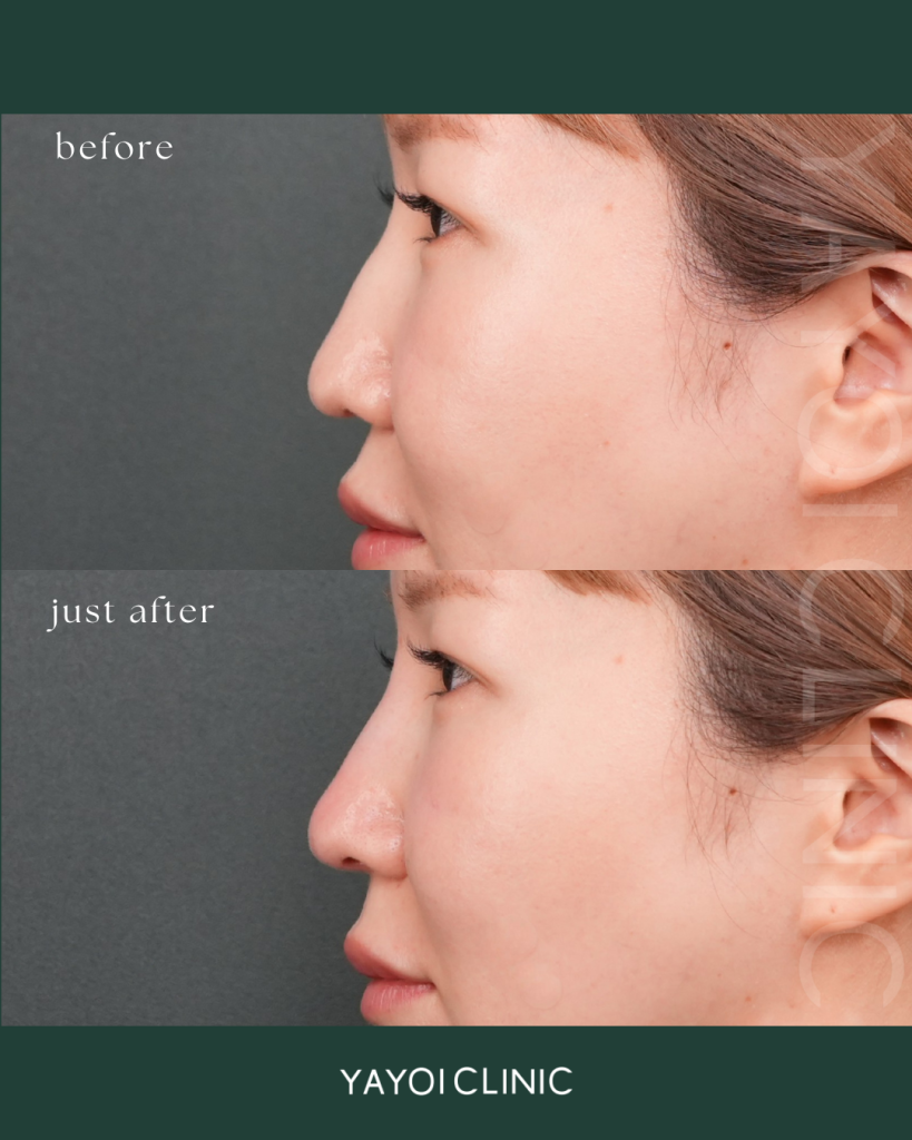 鼻ヒアルロン酸2.0