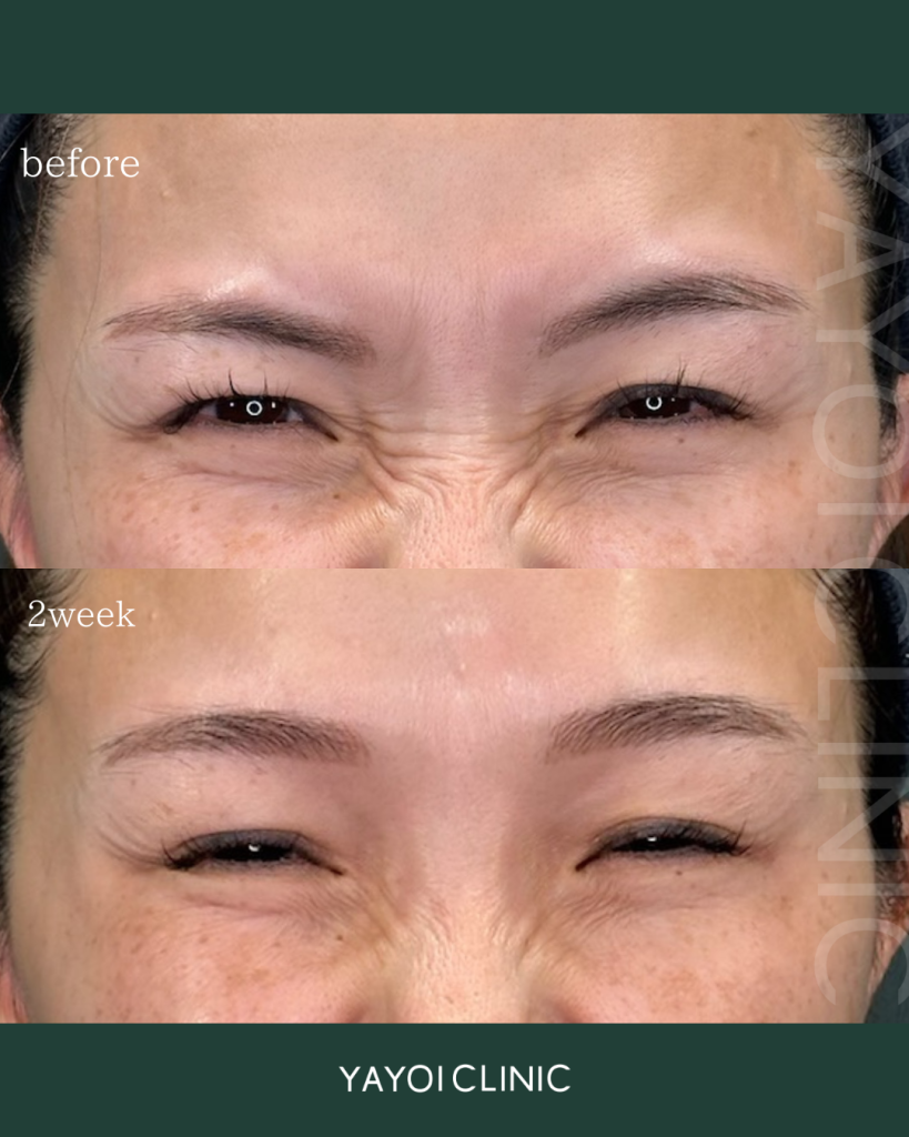 バニーボトックス