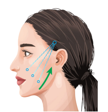 【糸リフト】広島で受ける前に知っておきたい効果・流れなどを解説