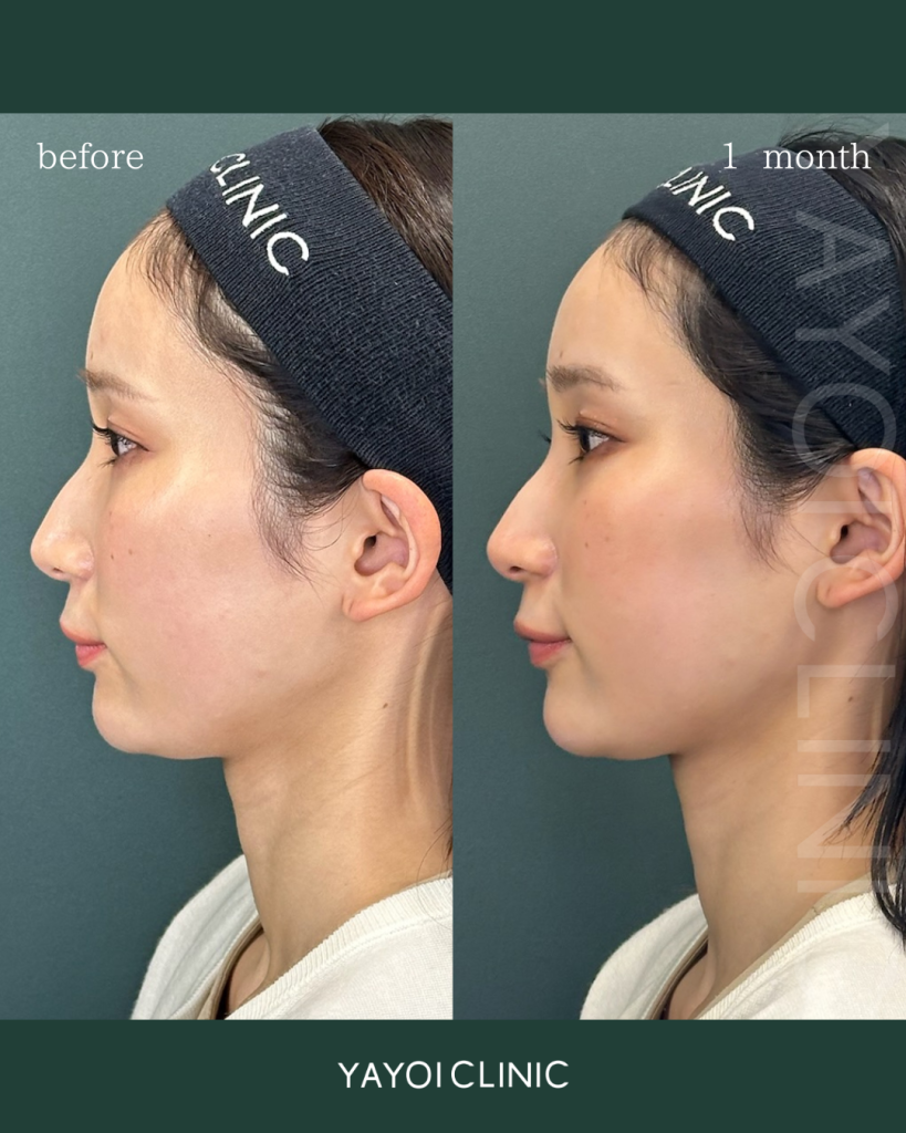 エラボトックス+ボトックスリフト