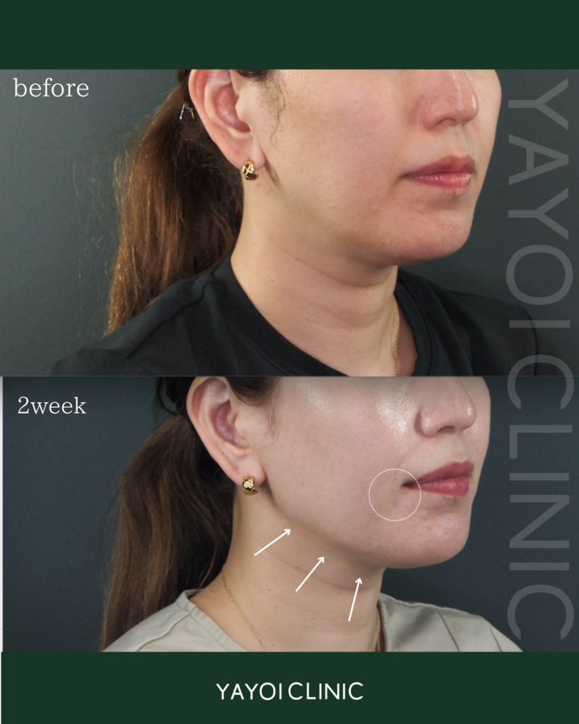 ショッピングリフト60本