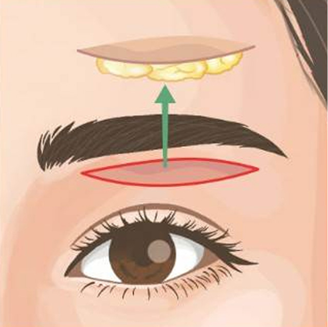 眉下リフトを広島で受ける！施術の仕組みや適した時期をヤヨイクリニックが解説