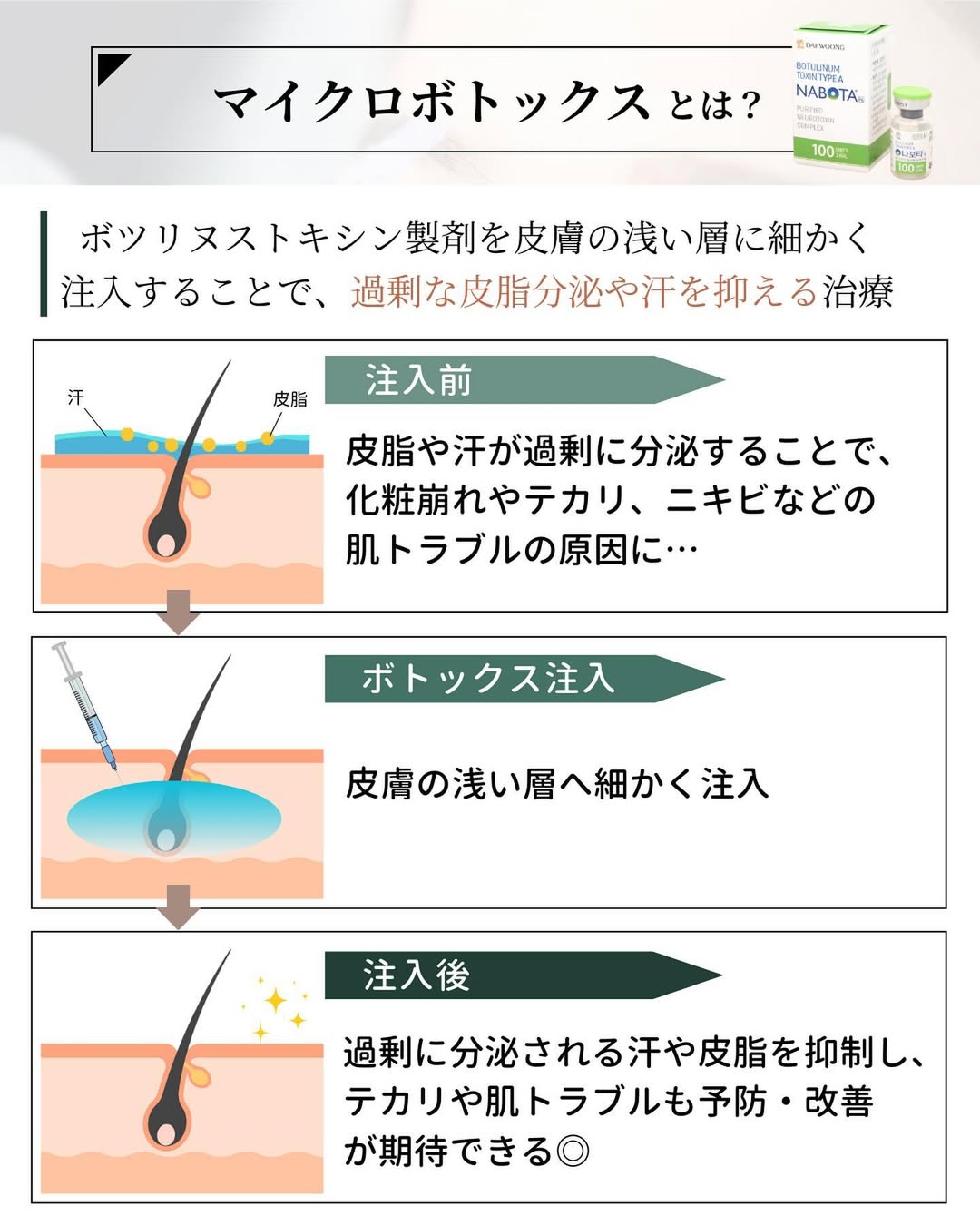 マイクロボトックスとは