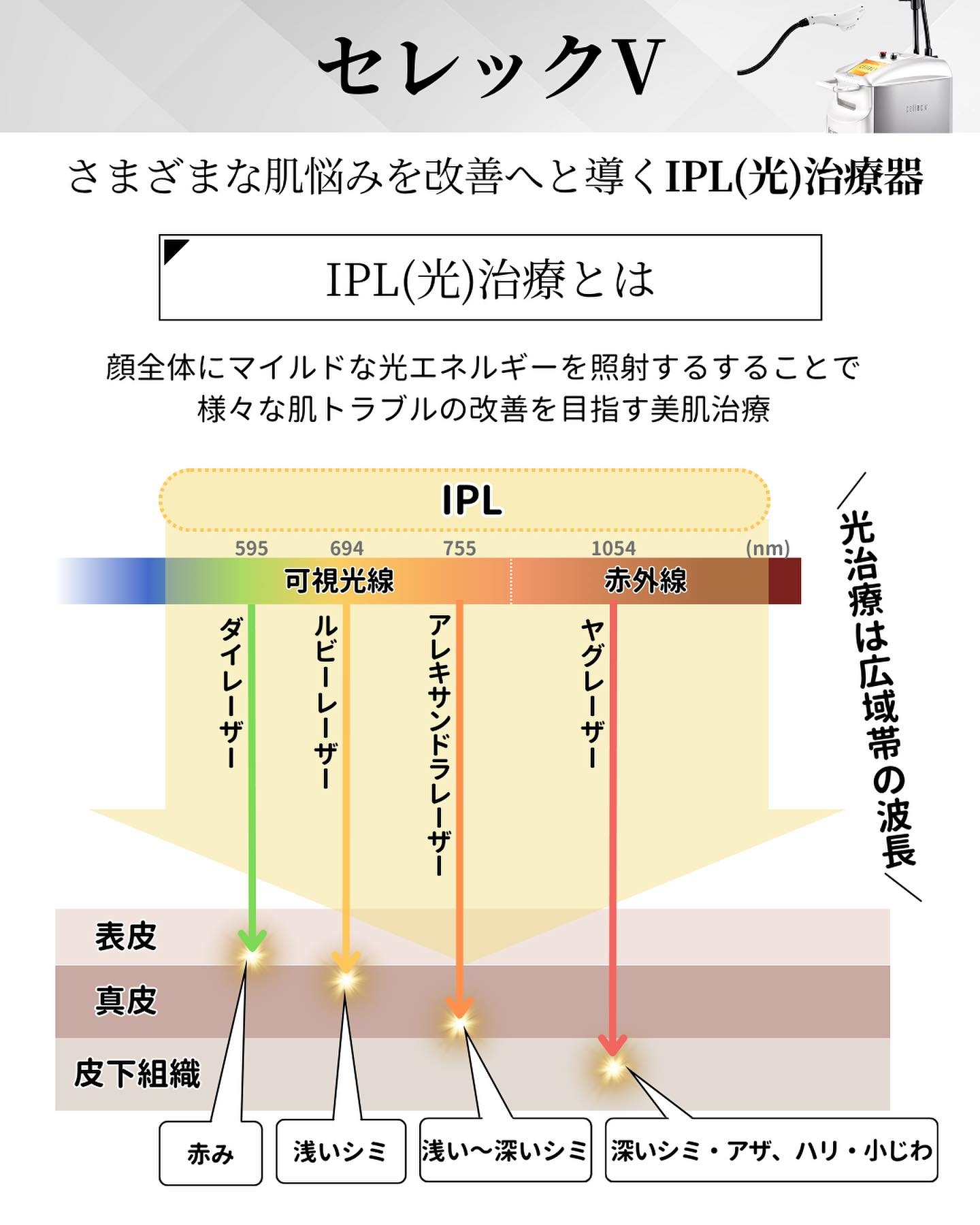 セレックVとは