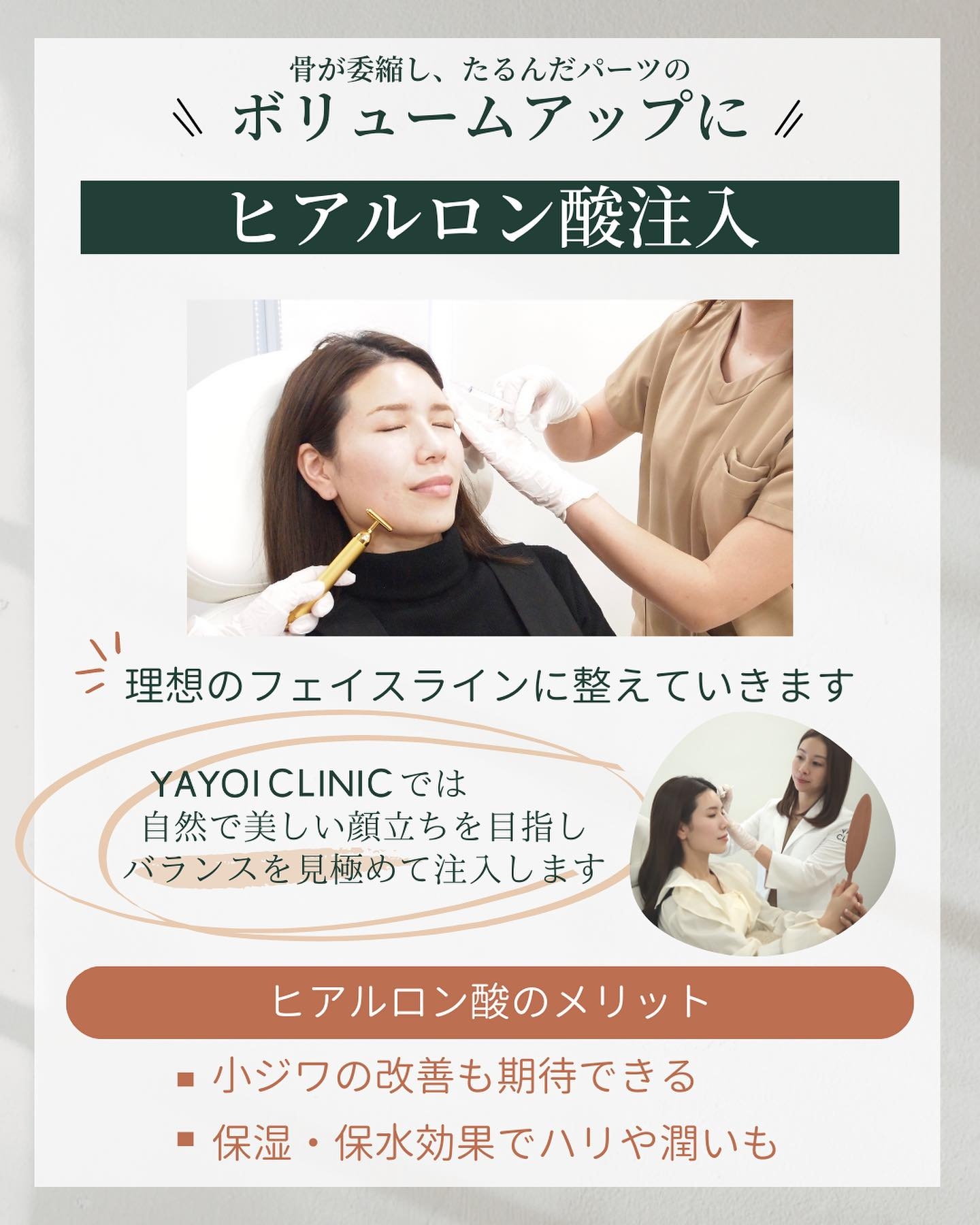 ほうれい線の凹みをボリュームアップして自然な仕上がりを目指すヒアルロン酸注入