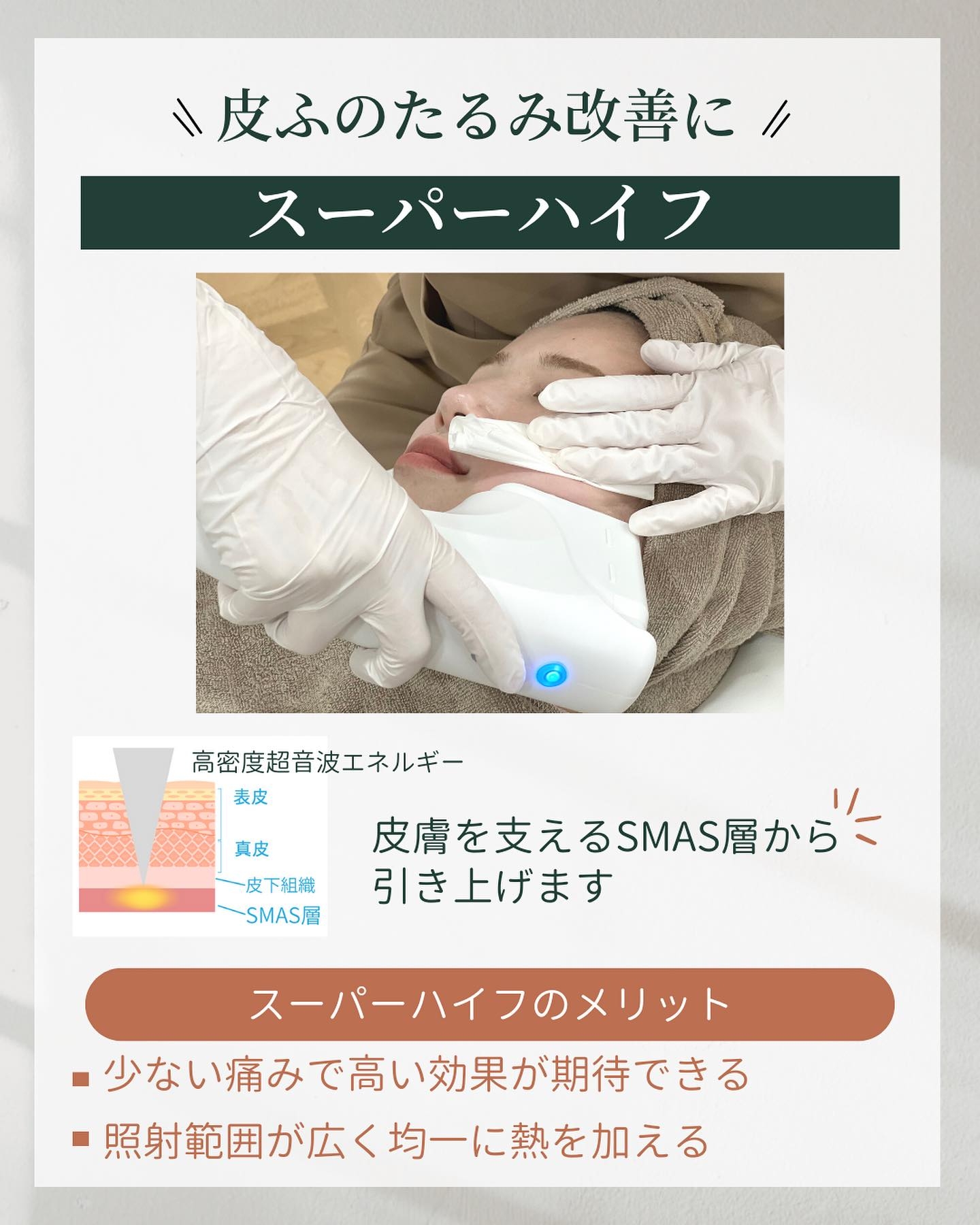 肌の深層(SMAS層)からたるみを引き上げるスーパーハイフによるほうれい線治療