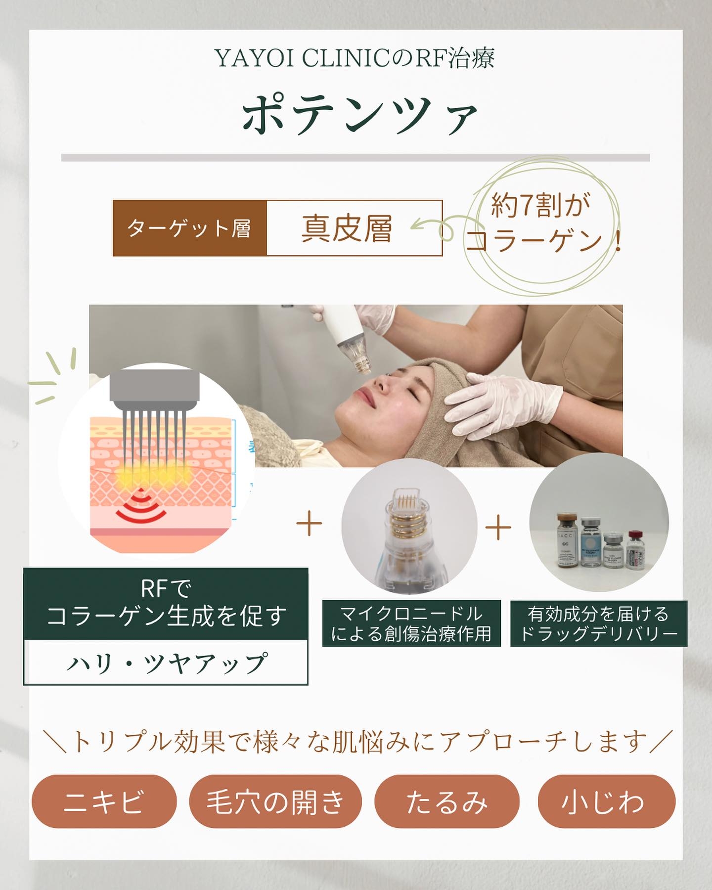 RF治療　ポテンツァ