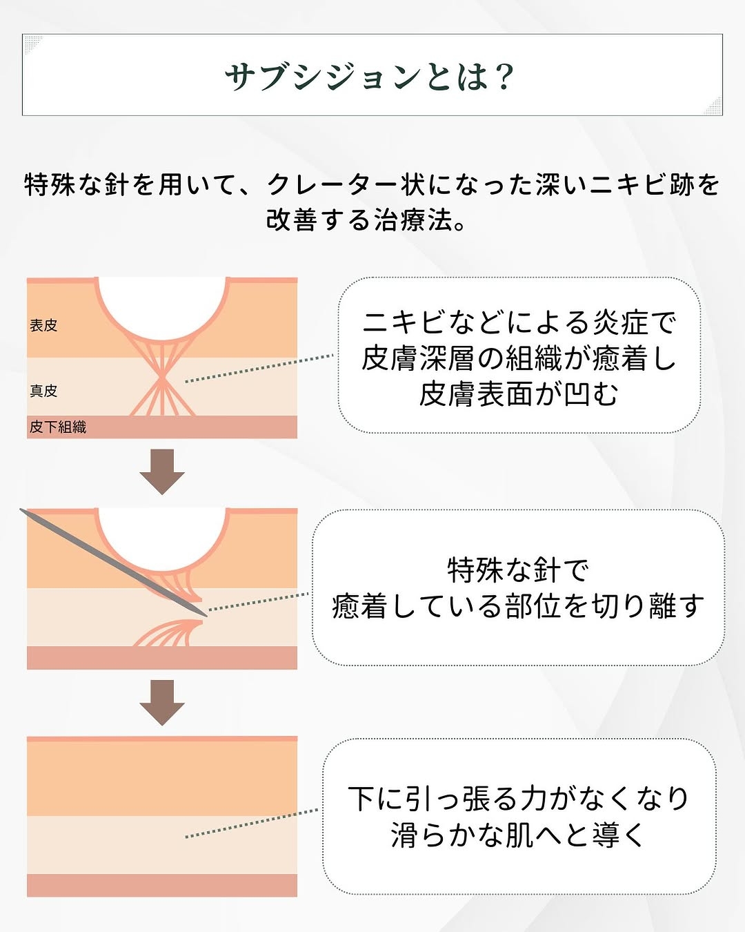 サブシジョンとは