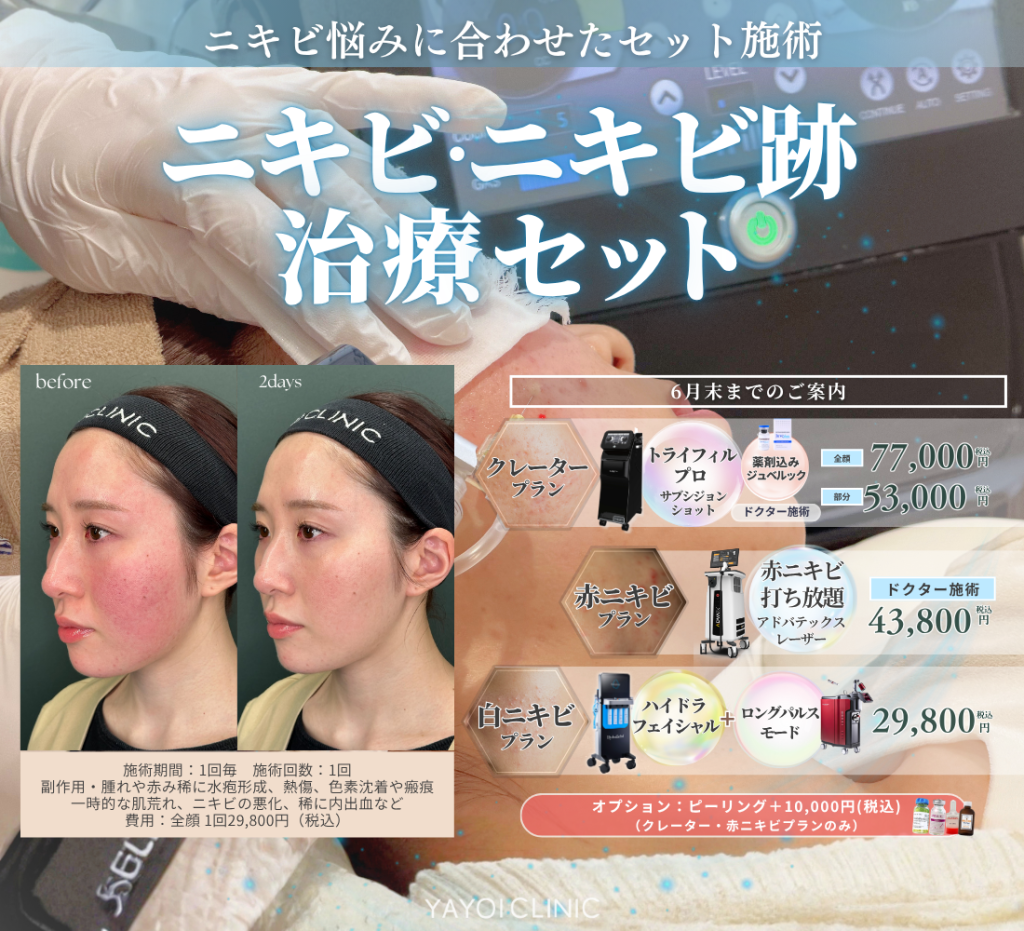 6月末日までのご案内☔｜ニキビ・ニキビ跡治療セット