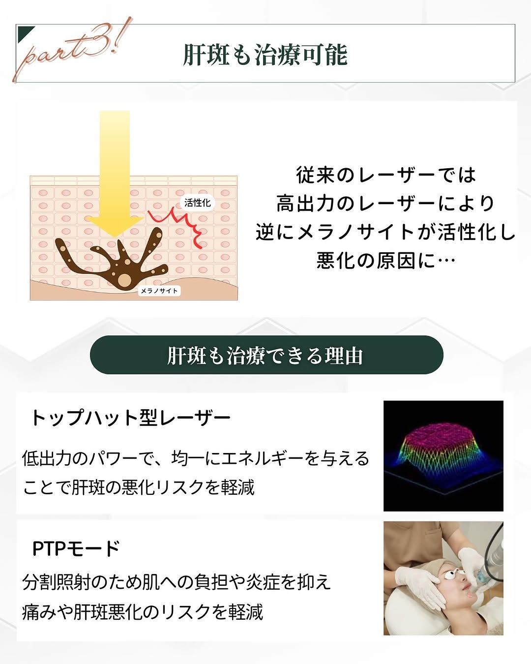 トライビームで肝斑治療