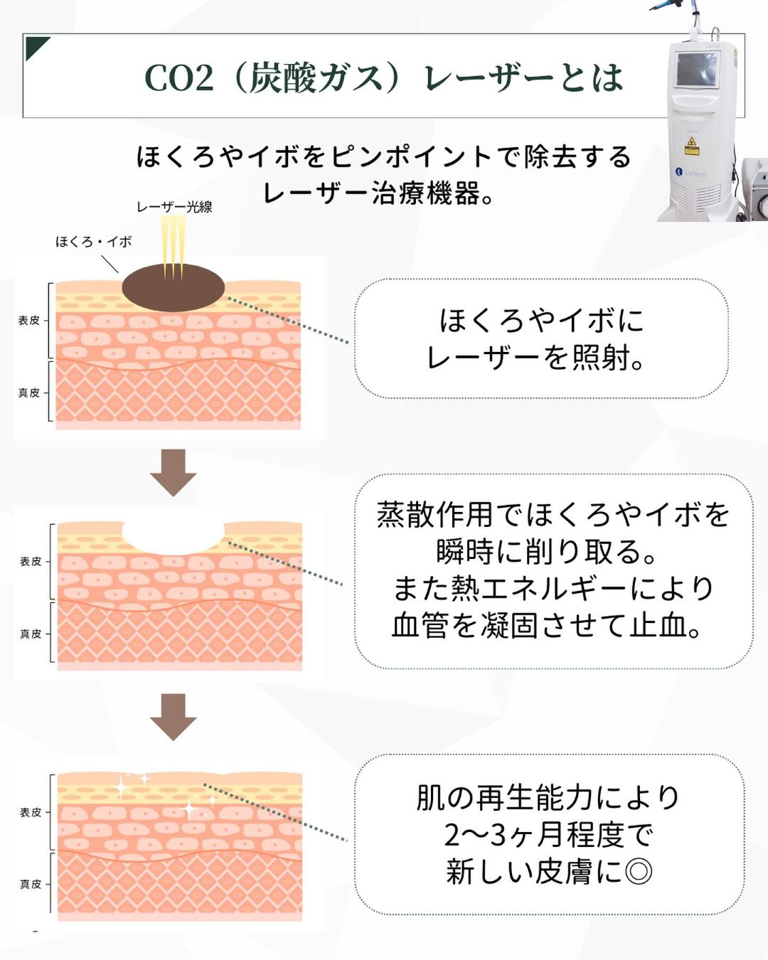 CO2 炭酸ガスレーザーとは