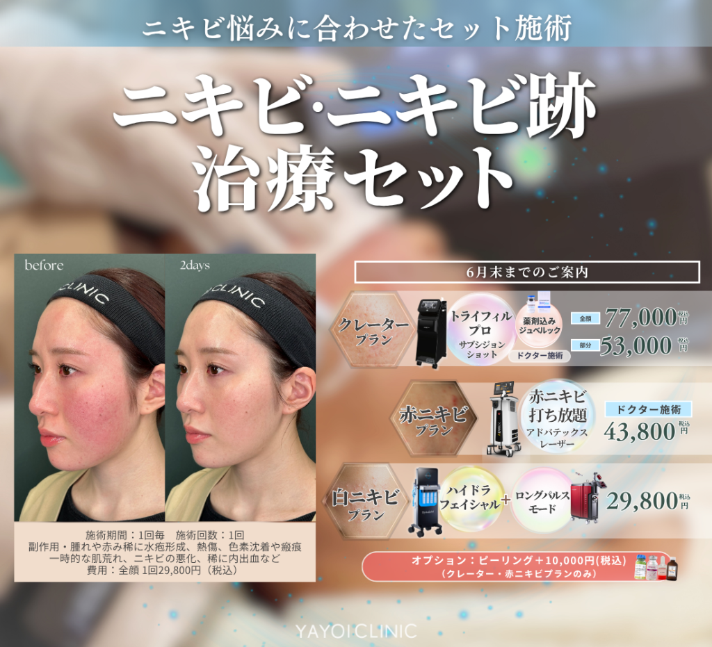 6月末日までのご案内☔｜ニキビ・ニキビ跡治療セット