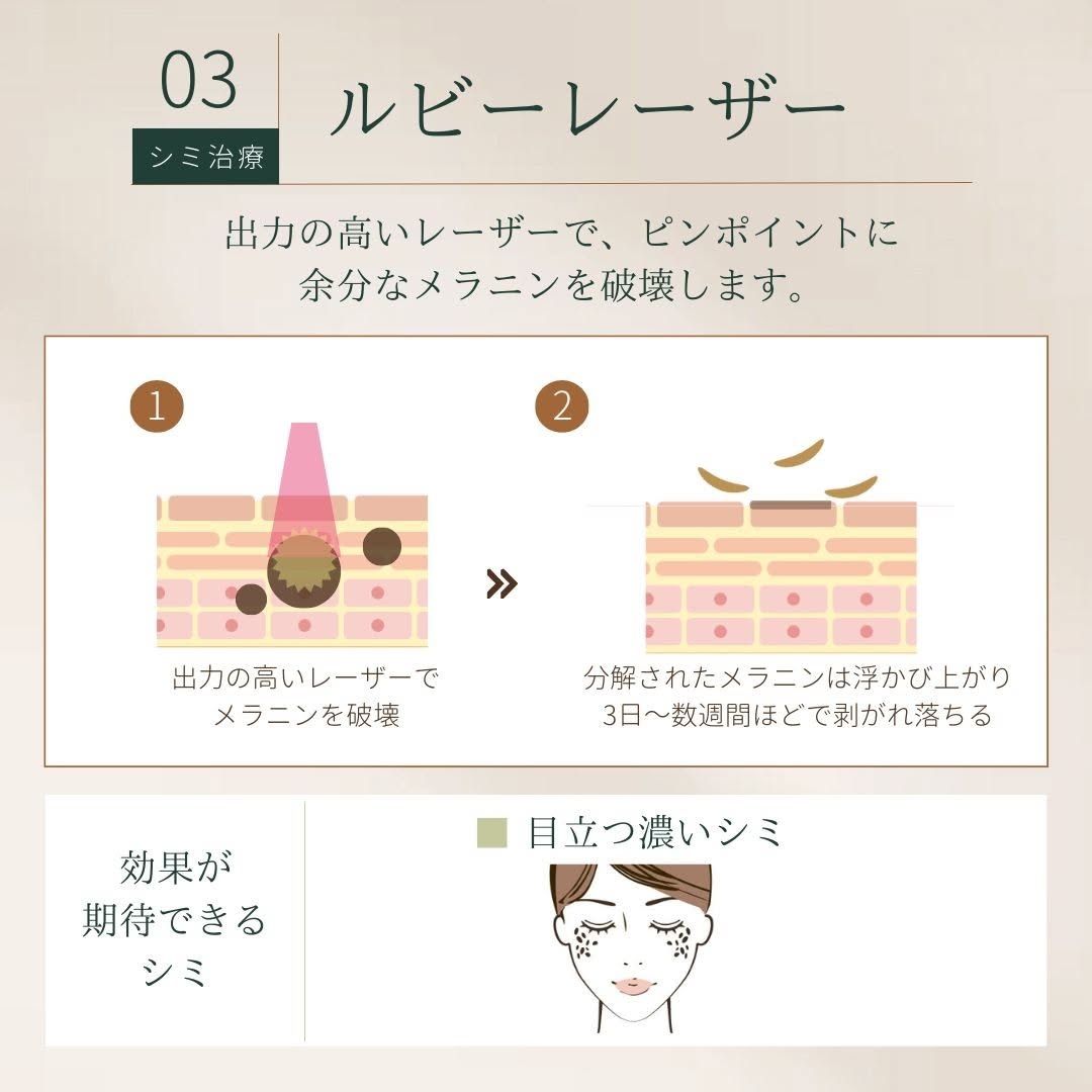 ルビーレーザー