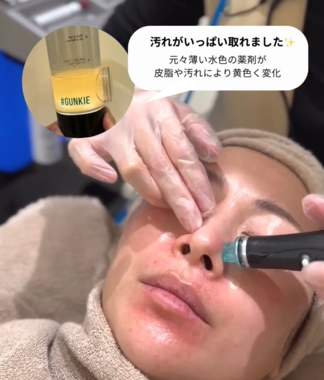 ハイドラフェイシャルの施術