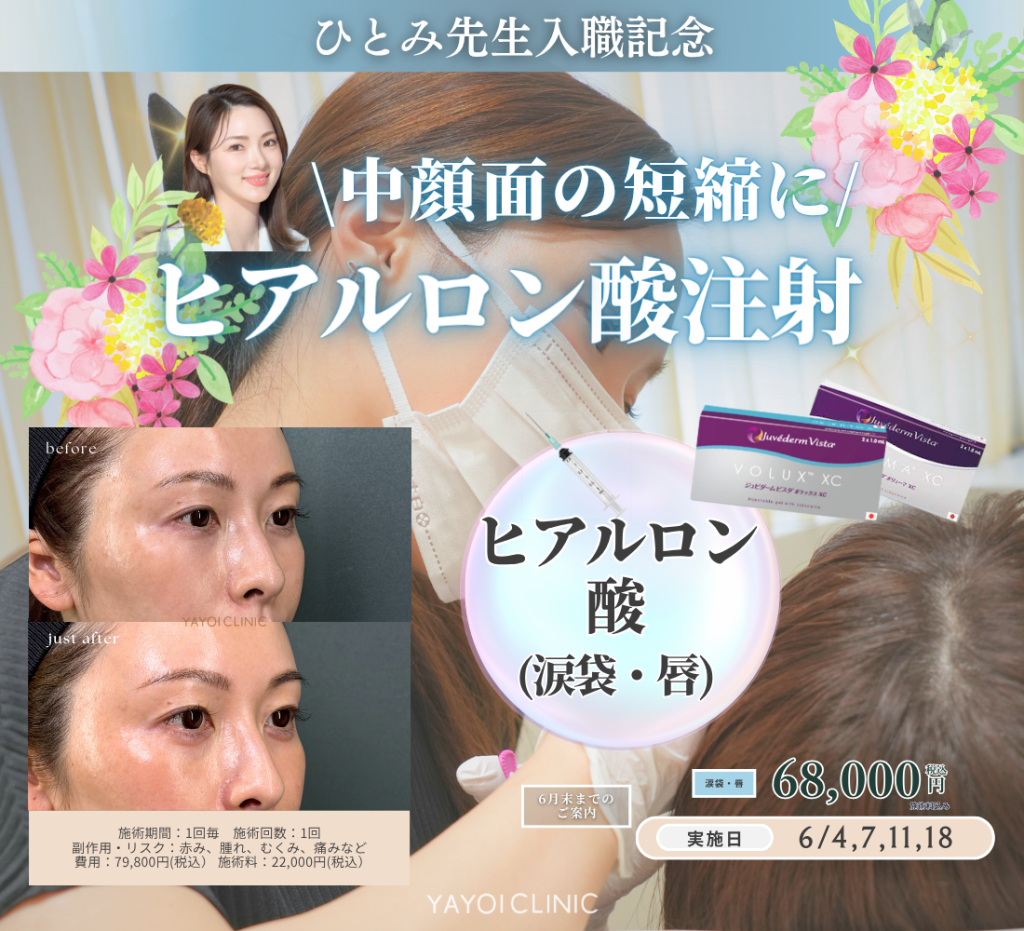 6月末日までのご案内☔｜中顔面短縮ヒアルロン酸注射