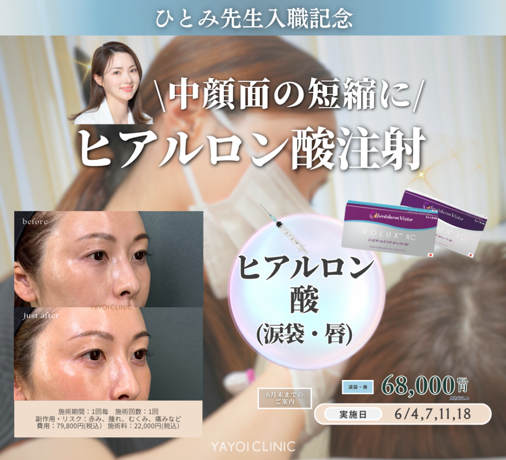 6月末日までのご案内☔｜中顔面短縮ヒアルロン酸注射
