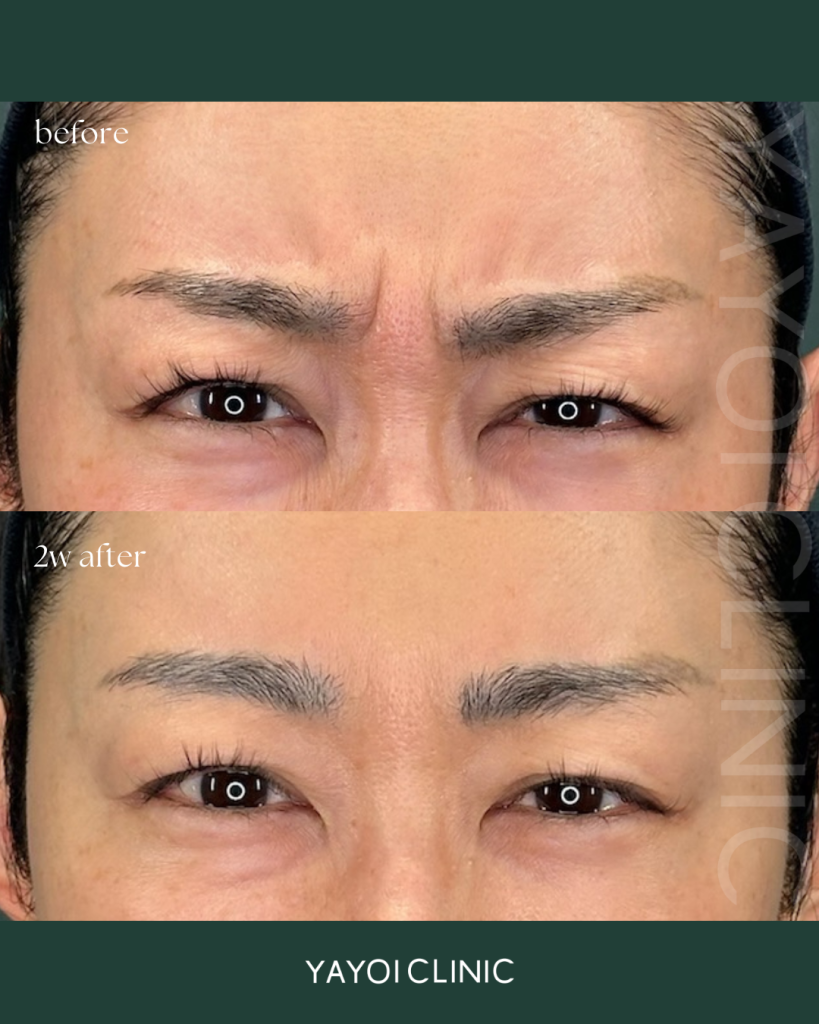 眉間ボトックス