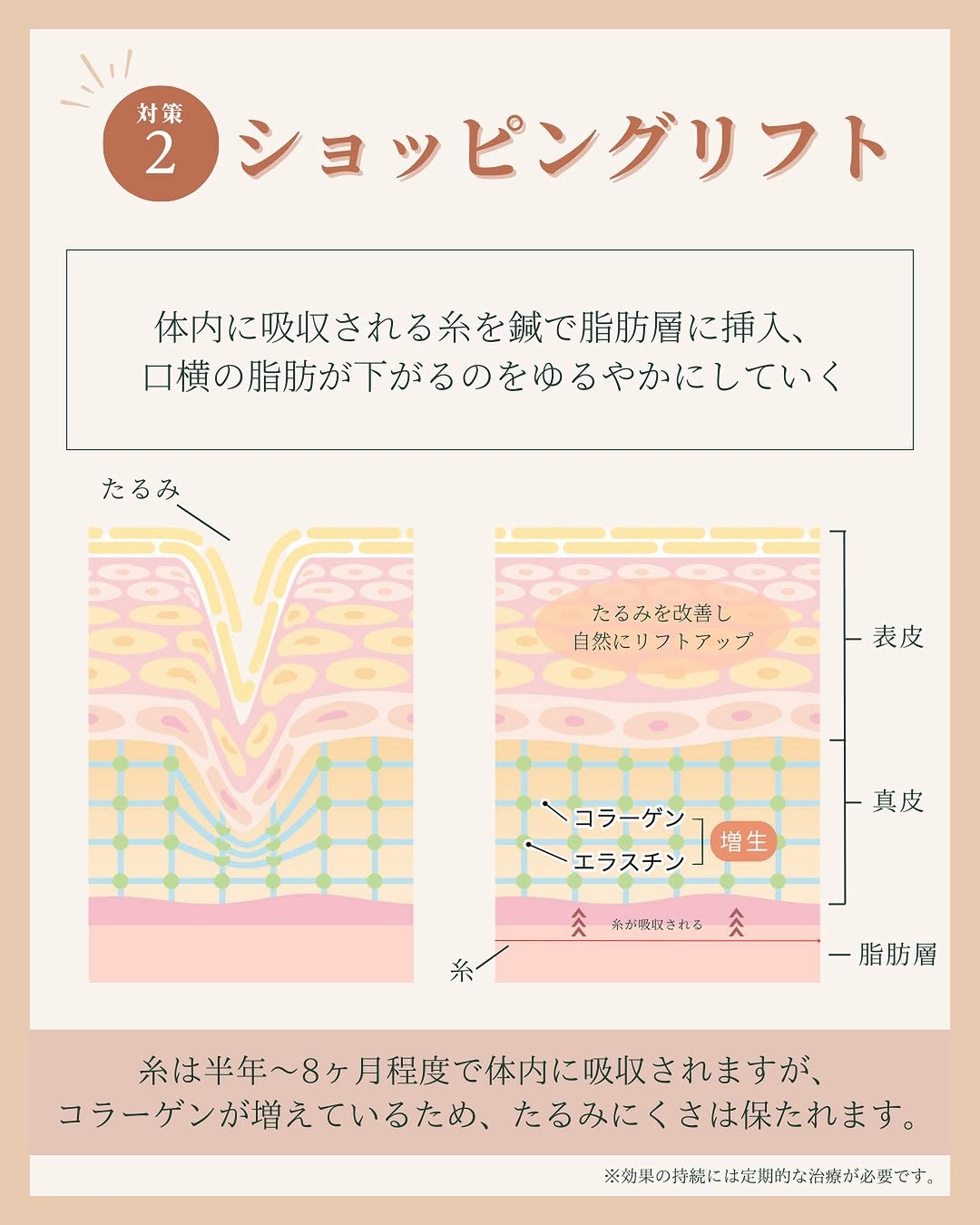 ショッピングリフトとは?
