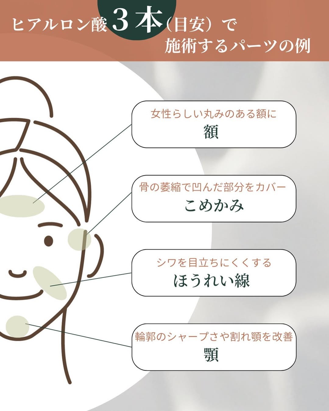 ヒアルロン酸3本で施術するパーツ例
