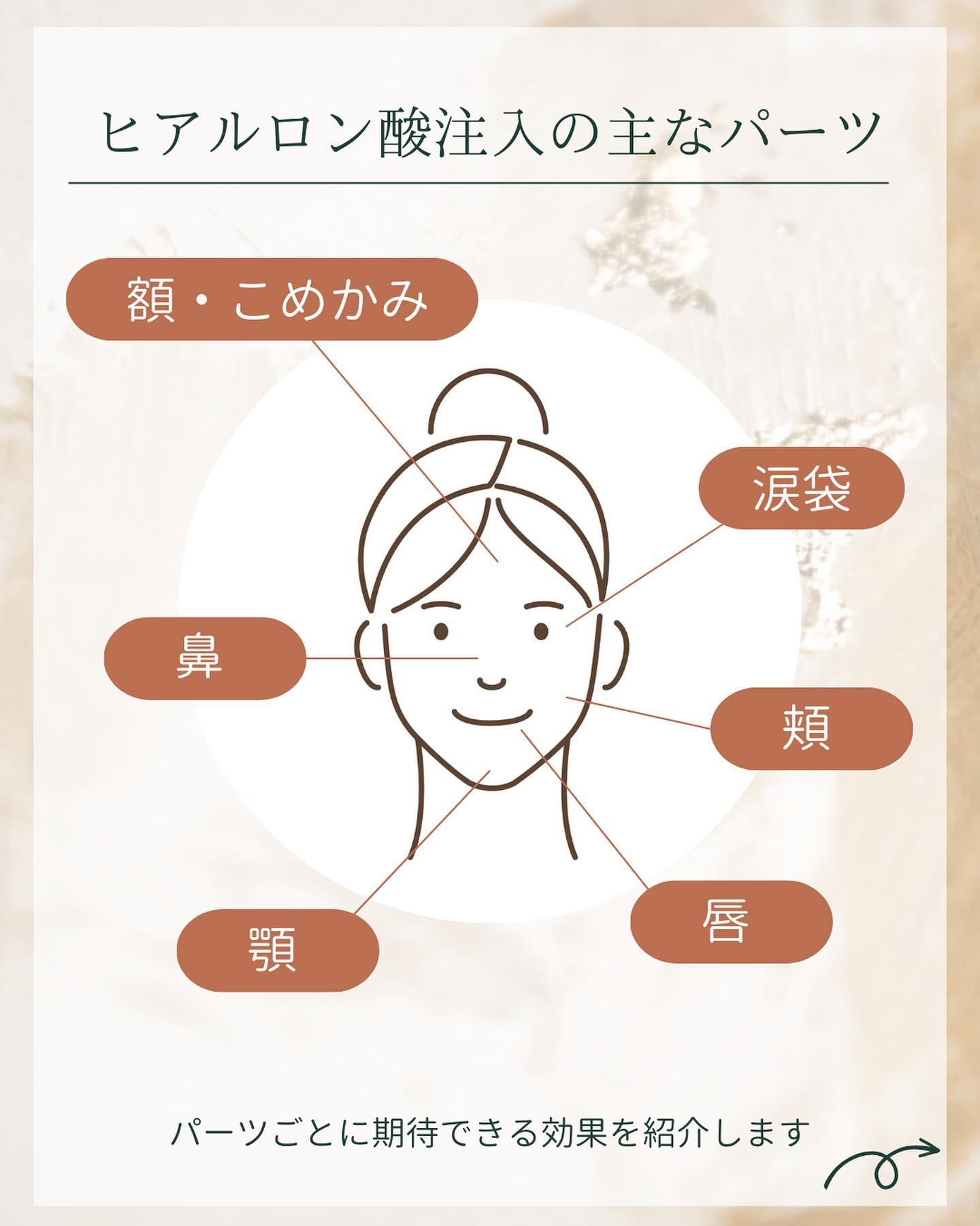 ヒアルロン酸注入の施術部位