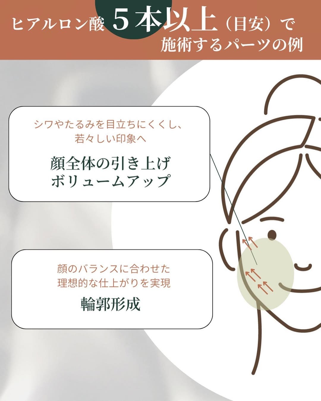 ヒアルロン酸5本以上で施術するパーツ例