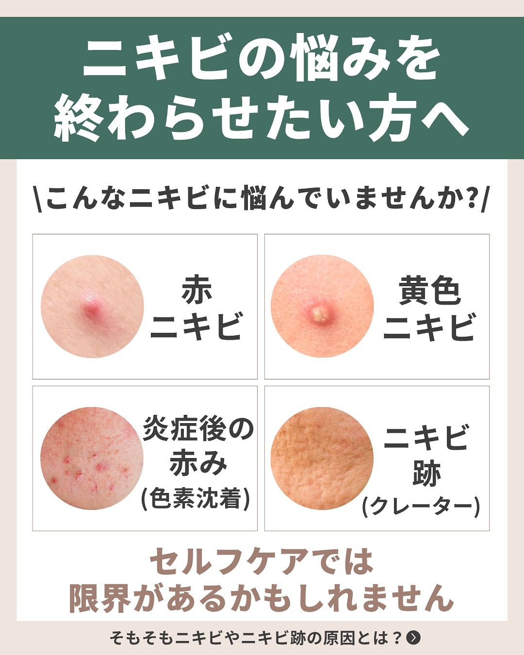 代表的なニキビの悩み