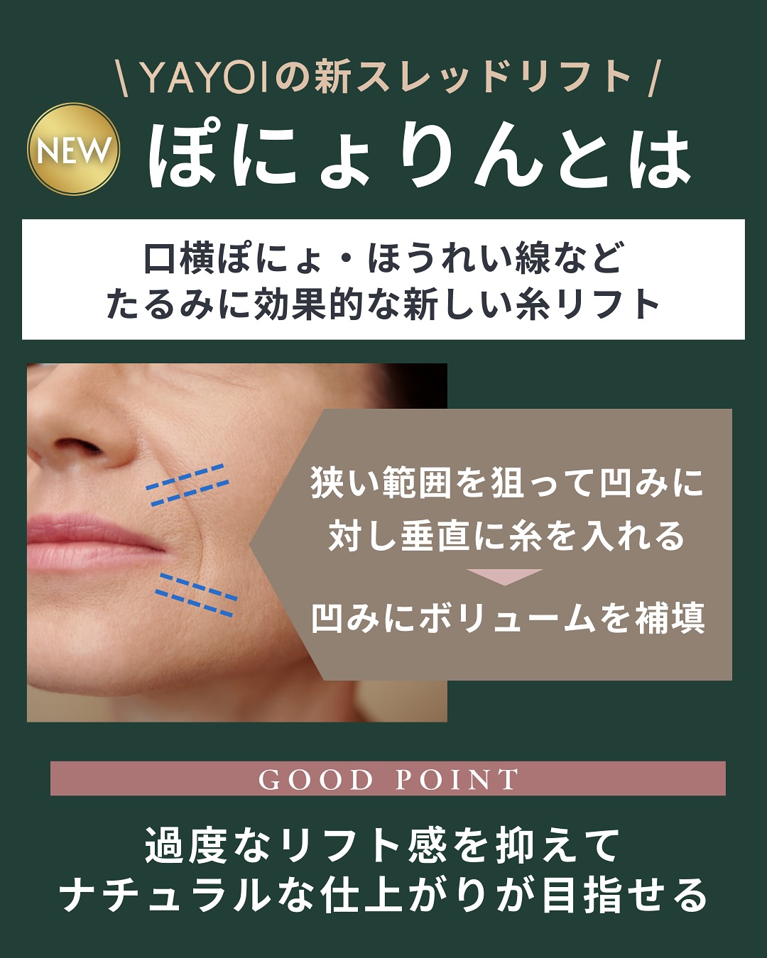 ぽにょりんとは