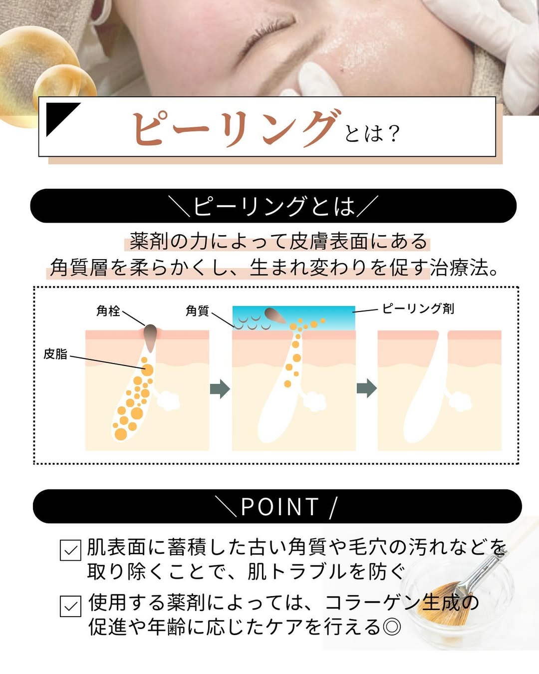 ピーリングとは?