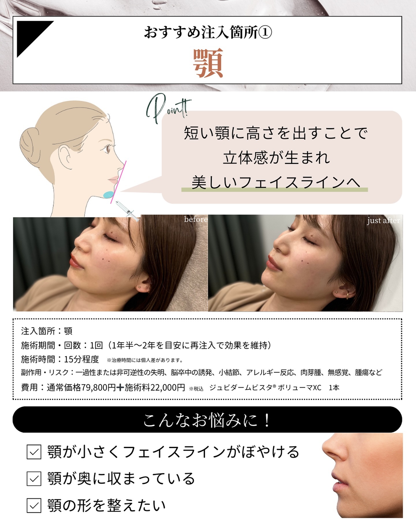 ヒアルロン酸注入 顎