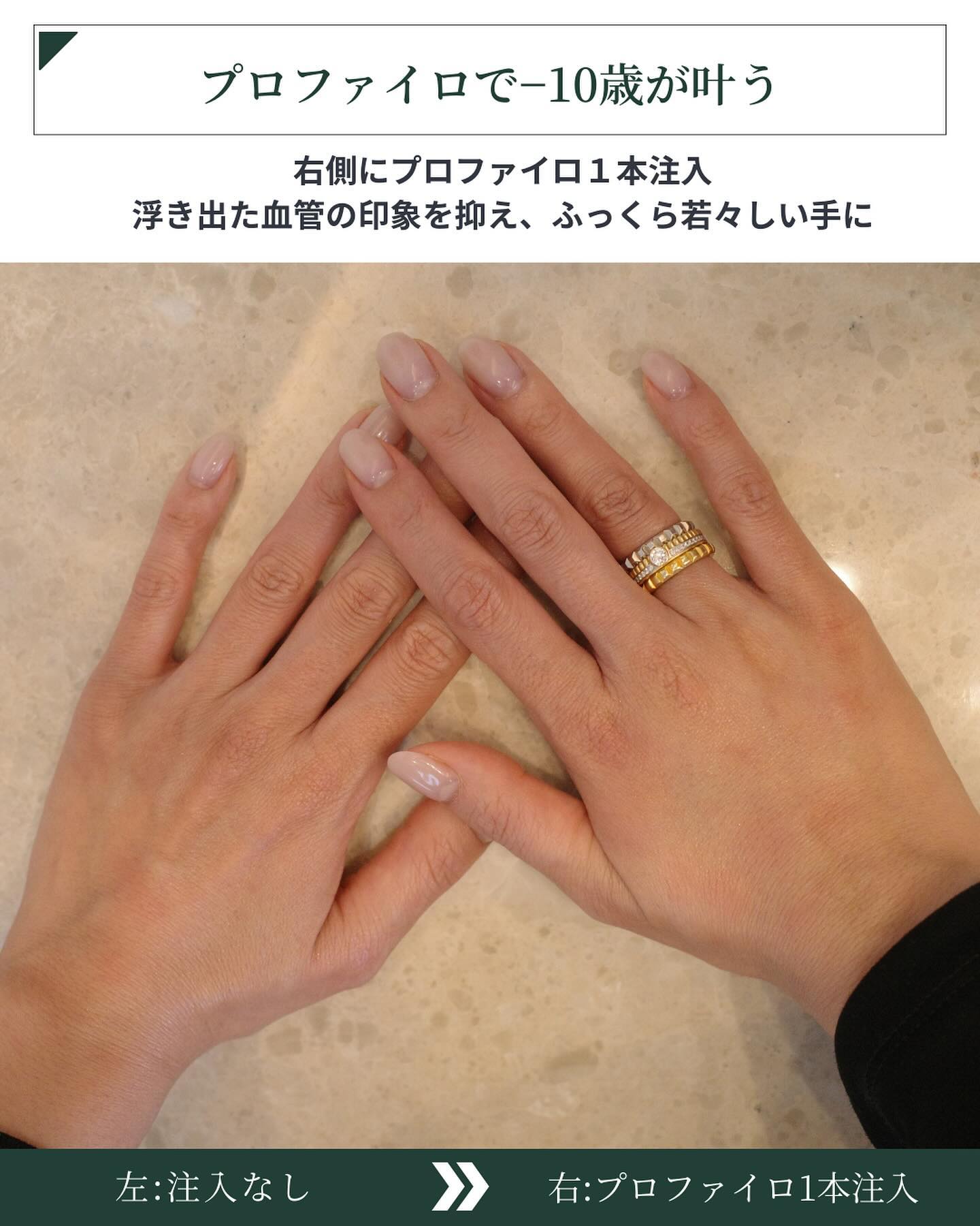 プロファイロ 効果 比較