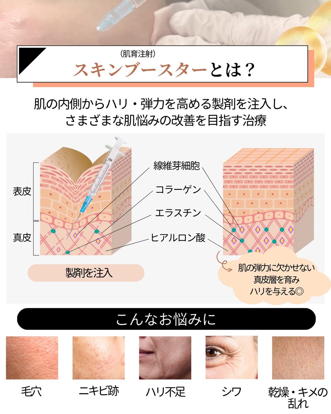 スキンブースターとは