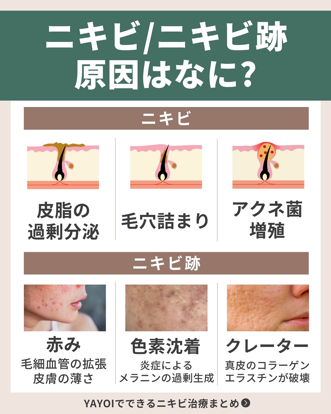 ニキビ・ニキビ痕の原因