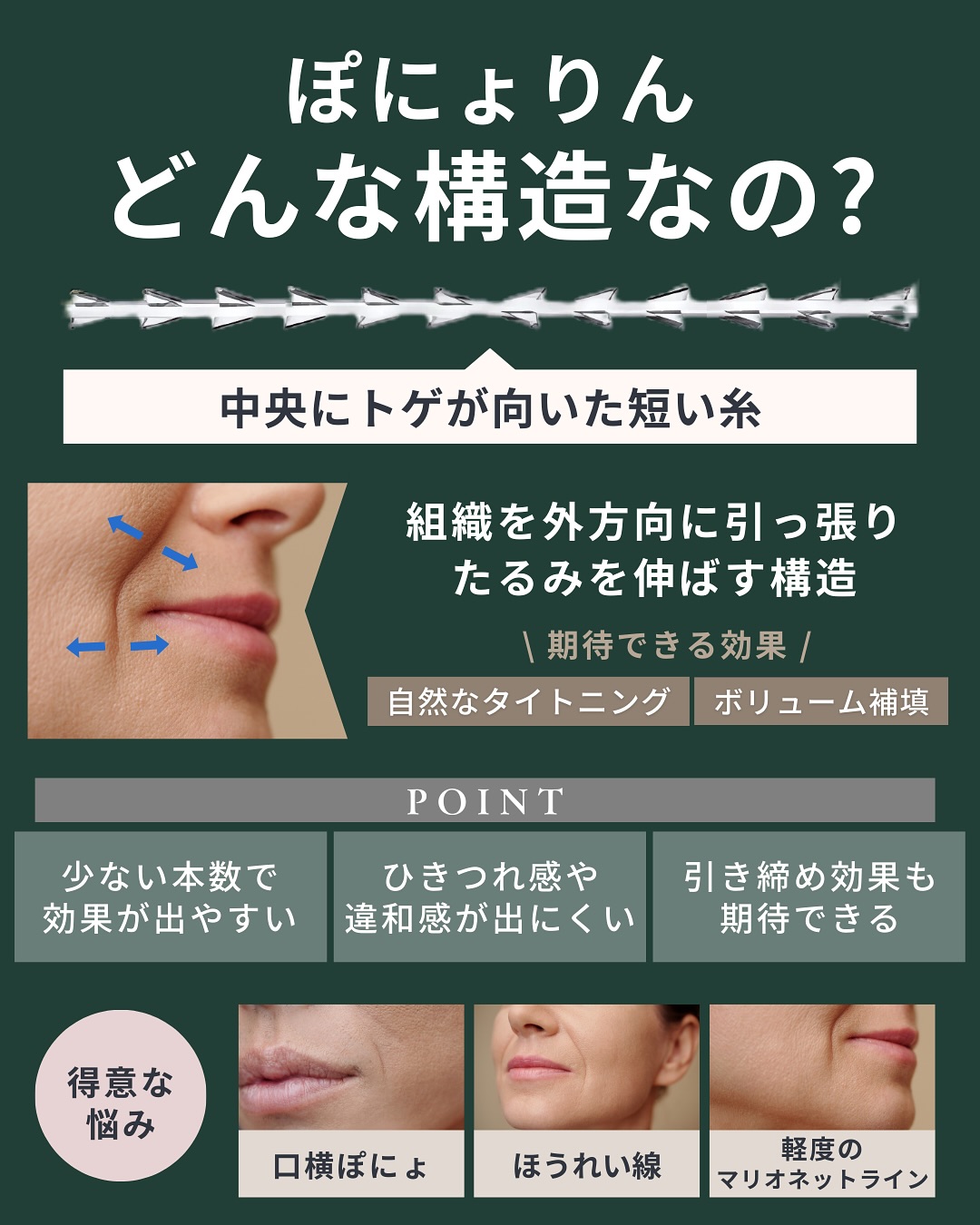 ぽにょりんとはどんな構造なの?