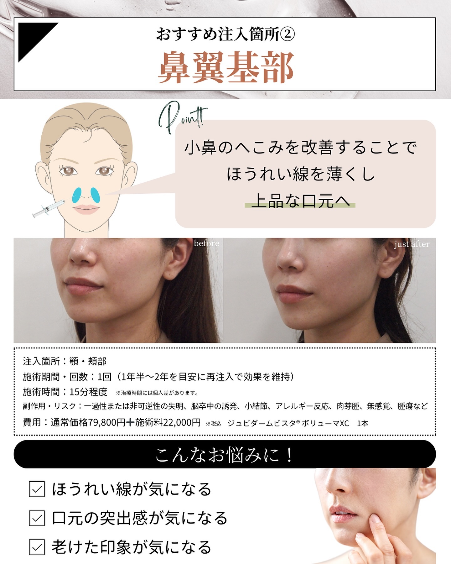 ヒアルロン酸注入 鼻翼基部