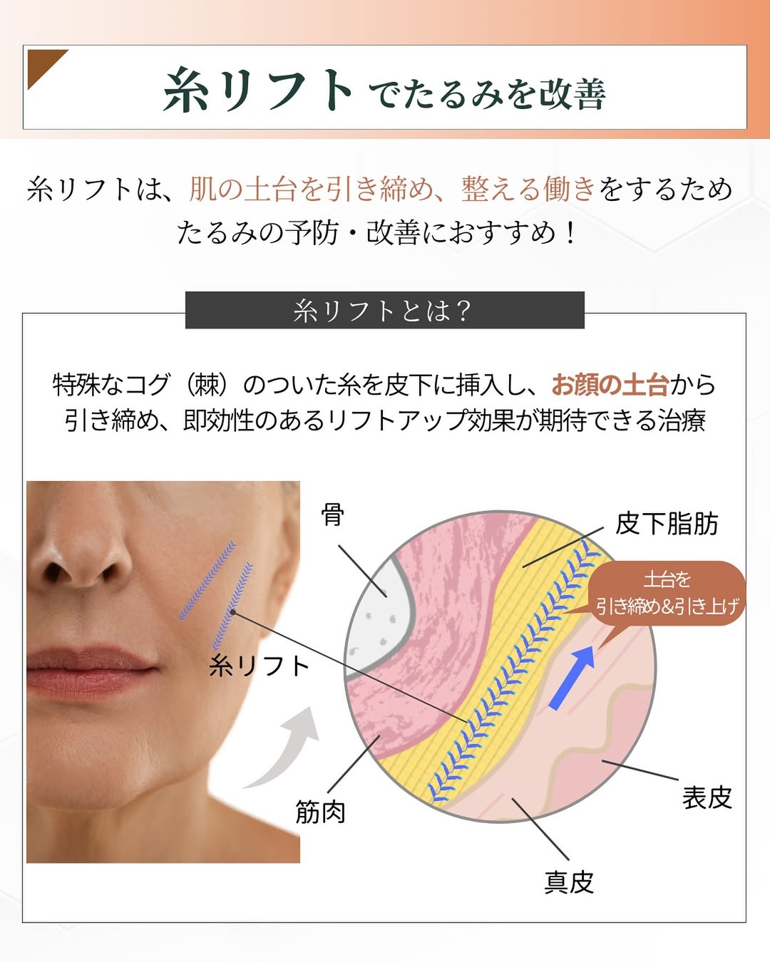 糸リフトでたるみケア