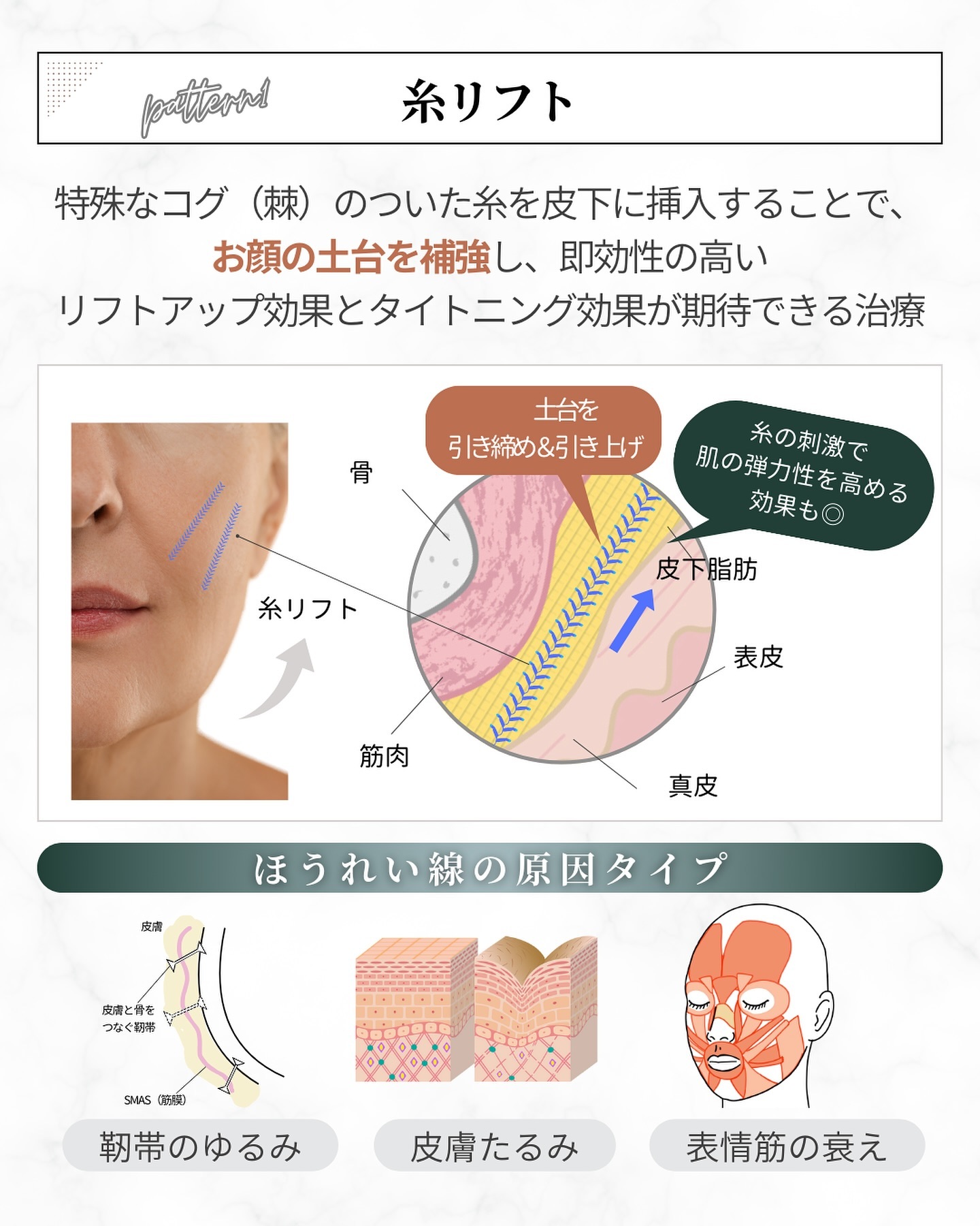 ほうれい線治療「糸リフト」の仕組み